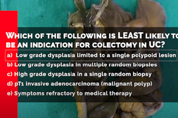 A screenshot from a video showing an organ on a dissecting table and a written summary about colectomys