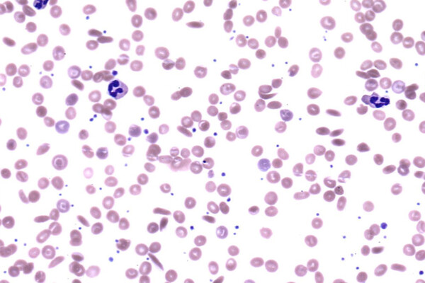 Peripheral Blood, Sickle cell anemia